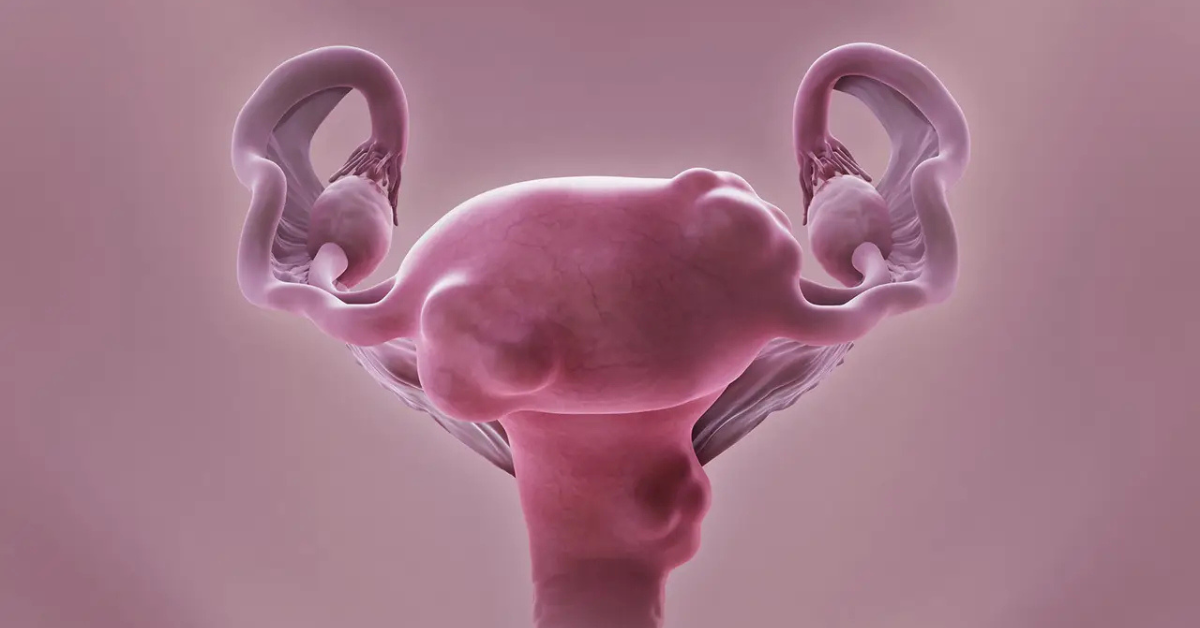 Μήτρα τεραστίων διαστάσεων: Η σημασία της εξειδίκευσης στη γυναικολογική χειρουργική